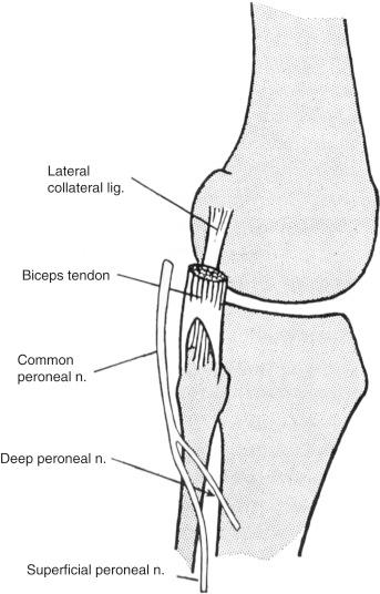 Fig. 162.3, The anatomic location of the common peroneal nerve makes it vulnerable to injury by direct pressure (e.g., stirrups). This is the most frequently damaged nerve in parturients.