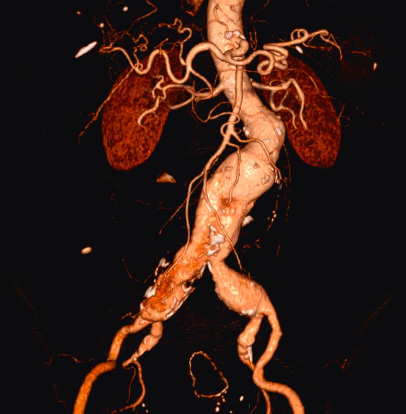 Figure 13.1, Reconstructed computed tomography aortogram of infra-renal aorto-iliac aneurysm.