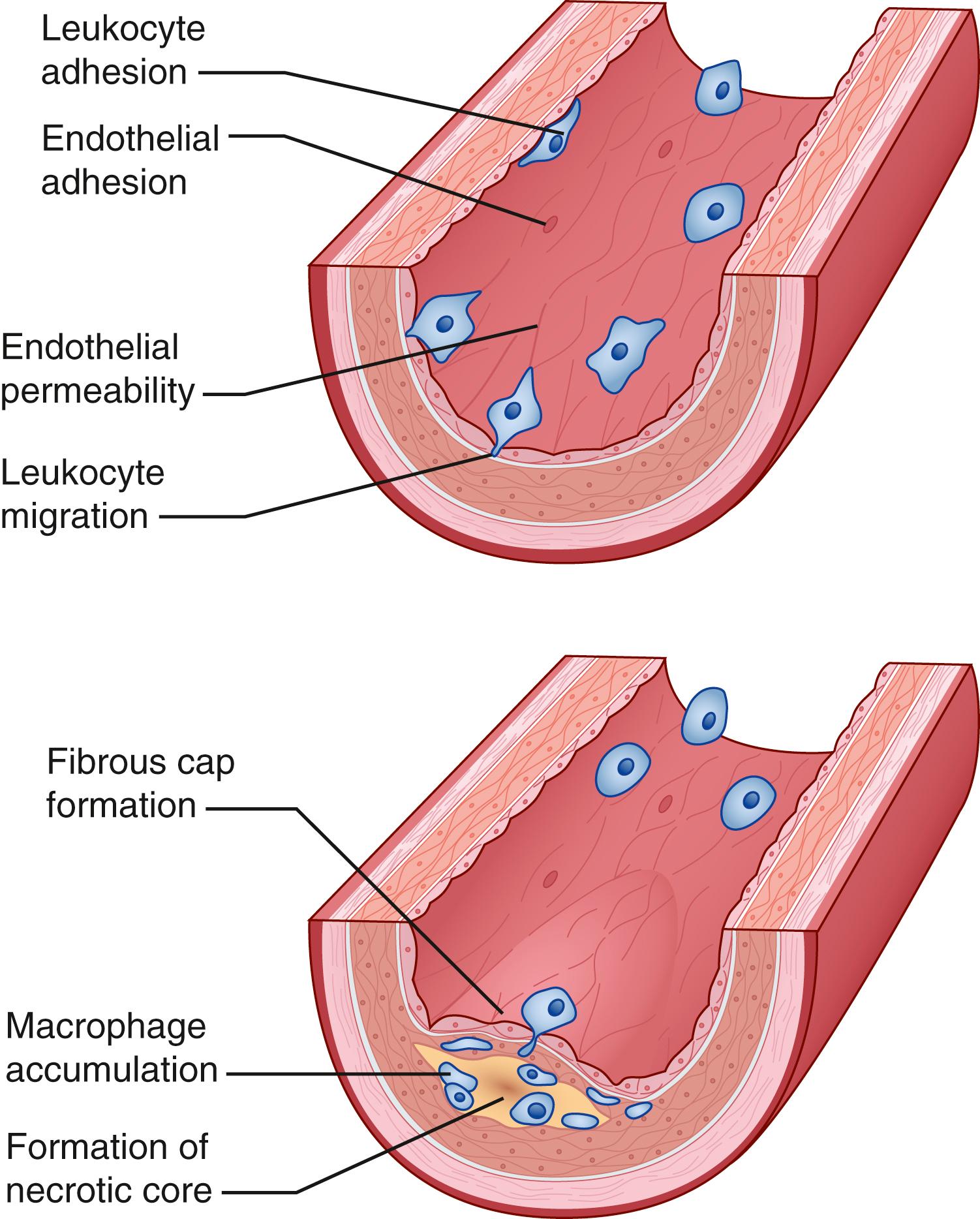 Fig. 63.3, Initiation and progression of atherosclerotic plaque. Cardiovascular risk factors, hemodynamic forces, toxins, and infectious agents interact with the vessel at the level of the endothelium to produce injury, resulting in decreased nitric oxide production and increased permeability. Once injured, the endothelium increases the expression of leukocyte adhesion molecules such as vascular cell adhesion molecule-1, intracellular adhesion molecule-1, and P- and E-selectin, which increases the adherence of macrophages and other leukocytes. Permeability of the endothelium also increases and permits entry of leukocytes and lipoproteins into the subendothelial space. Chemokines and cytokines such as monocyte chemotactic protein-1 and interleukin-8 further enhance the recruitment of leukocytes and smooth muscle cells (SMCs) into the subendothelial space. Lipoproteins retained in the subendothelial space are biochemically modified such that they can be taken up by macrophages and SMCs to form foam cells. Foam cells at the central-most position of the developing atheroma become necrotic and form the central lipid core, whereas the shoulder regions contain SMCs, macrophages, and other leukocytes. Platelet-derived growth factor and transforming growth factor-β stimulate SMC migration and collagen formation in the subendothelial space, as well as formation of the fibrous cap.