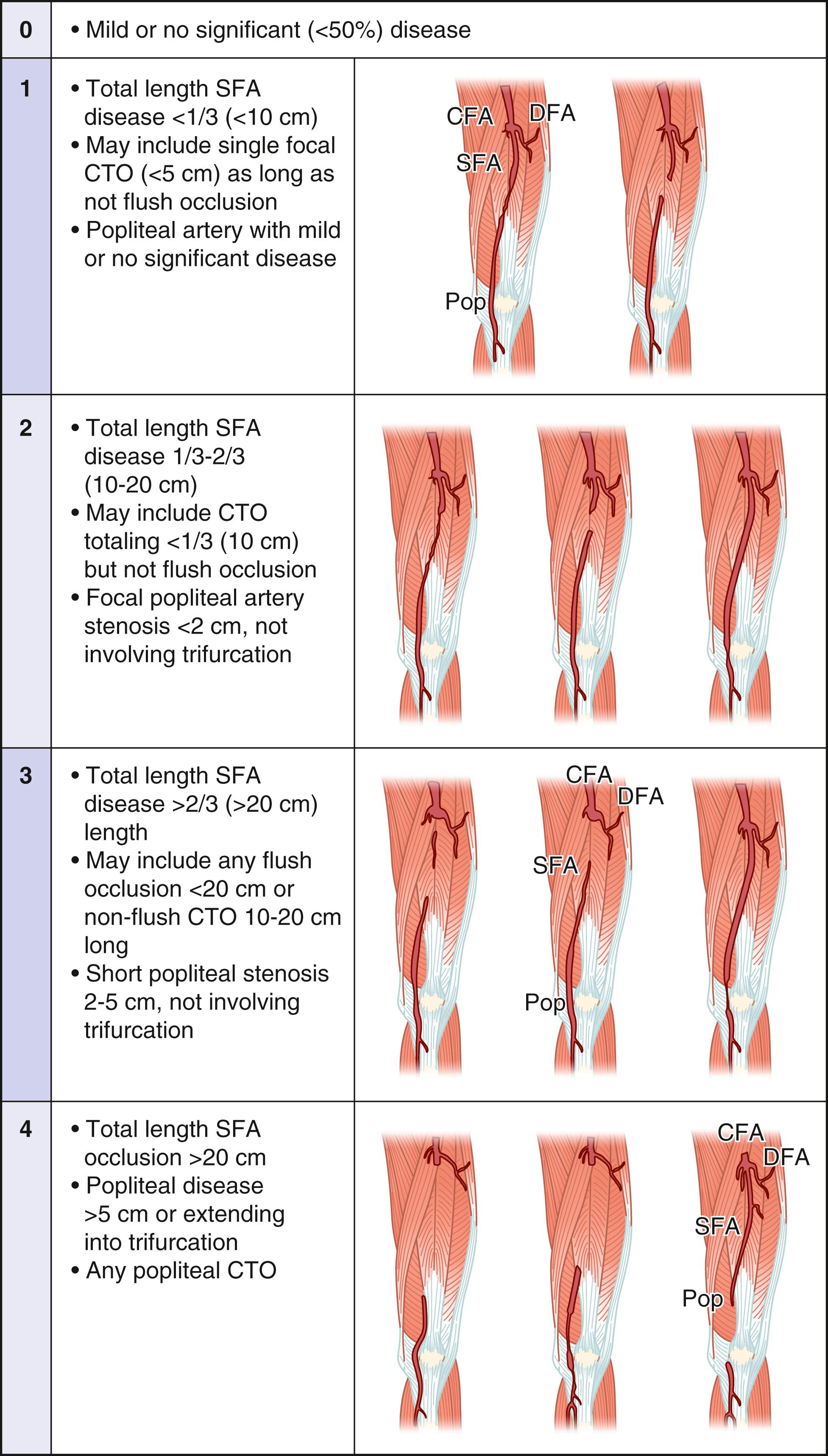 Fig. 63.7, Femoropopliteal (FP) disease grading in Global Limb Anatomic Staging System (GLASS). Trifurcation is defined as the termination of the popliteal artery at the confluence of the anterior tibial (AT) artery and tibioperoneal trunk.(From Conte MS, Bradbury AW, Kolh P, et al. Global vascular guidelines on the management of chronic limb-threatening ischemia. J Vasc Surg. 2019;69:3S–125S e140. CFA , Common femoral artery; CTO , chronic total occlusion; DFA , deep femoral artery; Pop , popliteal; SFA , superficial femoral artery.