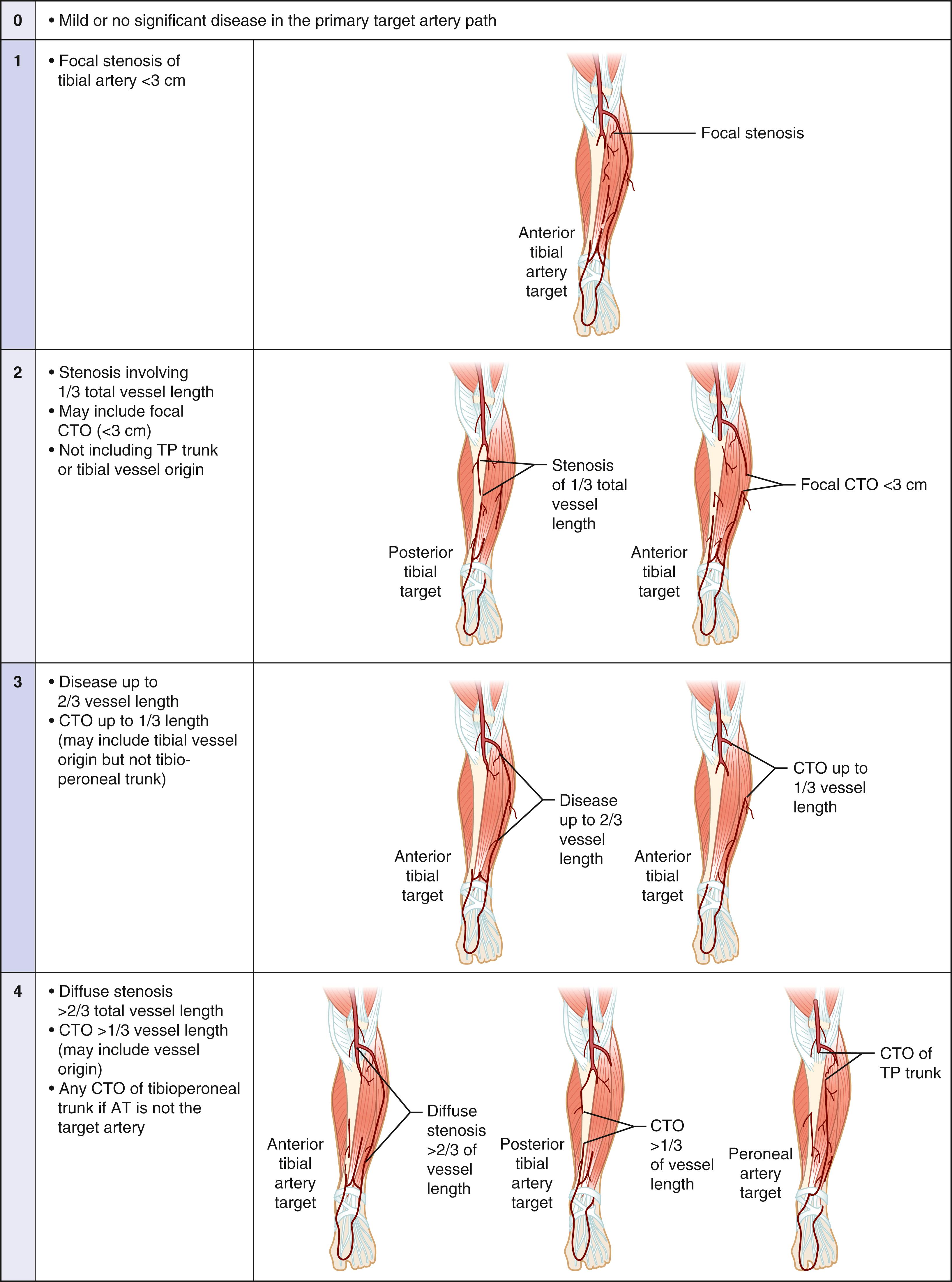 Fig. 63.8, Infrapopliteal (IP) disease grading in Global Limb Anatomic Staging System (GLASS).(From Conte MS, Bradbury AW, Kolh P, et al. Global vascular guidelines on the management of chronic limb-threatening ischemia. J Vasc Surg. 2019;69:3S–125S e140.) AT , Anterior tibial; CTO , chronic total occlusion; TP , tibioperoneal.