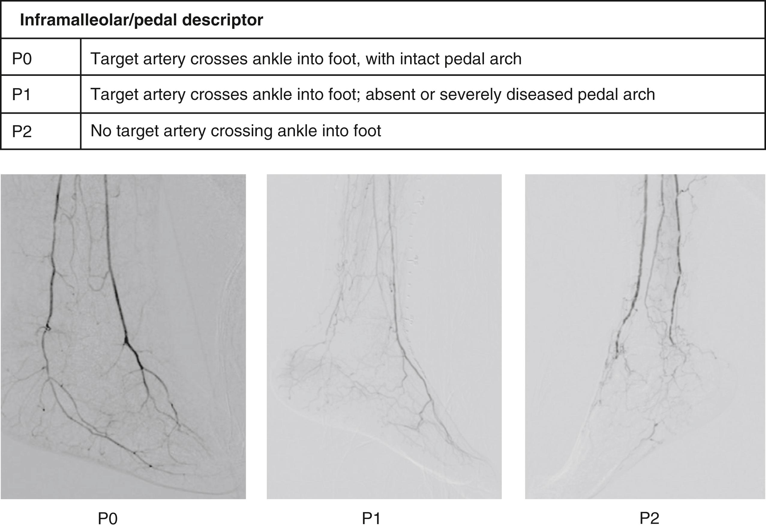 Fig. 63.9, Inframalleolar (IM)/pedal disease descriptor in Global Limb Anatomic Staging System (GLASS). Representative angiograms of P0 (left), P1 (middle), and P2 (right) patterns of disease.