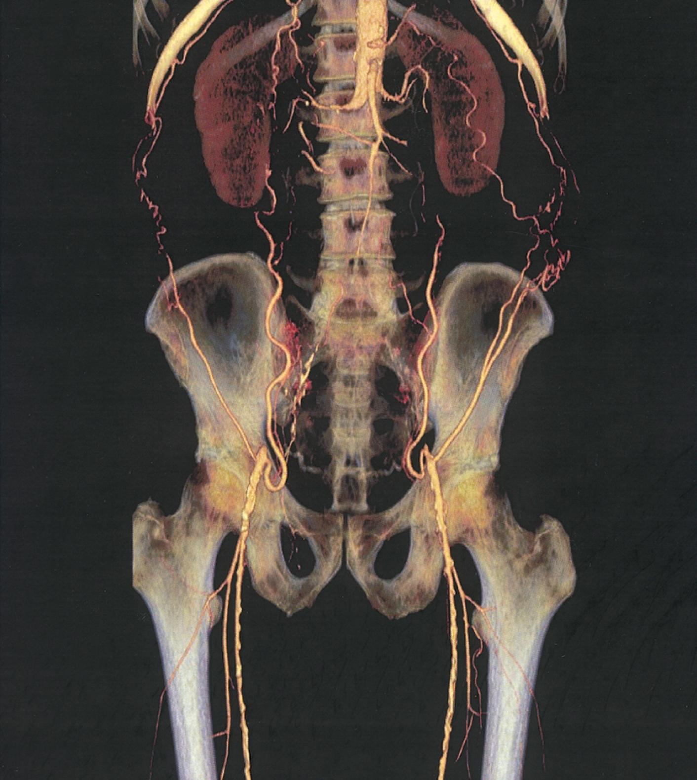 FIGURE 43.7, CTA in a patient with complete occlusion of the aorta and both iliac arteries. The common femoral arteries have been reconstituted.