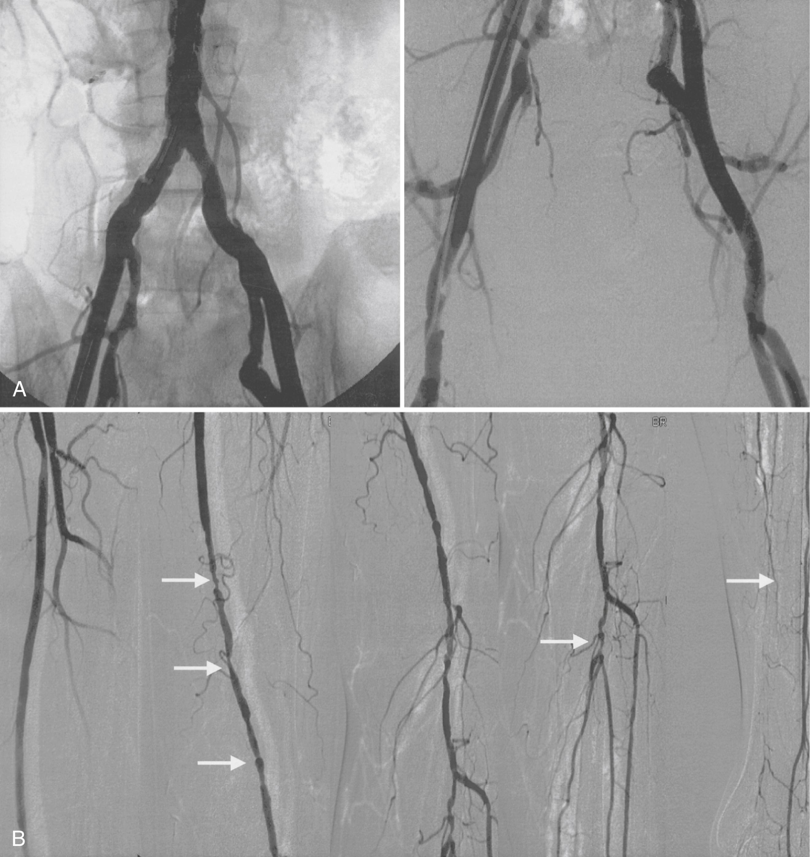 FIGURE 43.8, Angiogram of a patient with disabling left calf claudication. A, The aorta and bilateral common iliac arteries are patent. B, The left superficial femoral artery has multiple stenotic lesions ( left arrows ). Significant stenosis of the left tibioperoneal trunk and left posterior tibial artery ( right arrows ) is present.