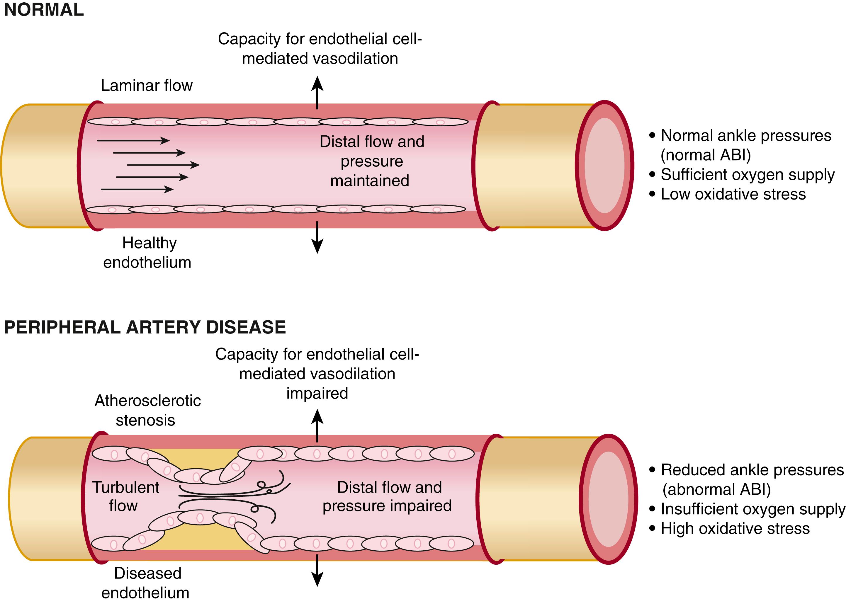 FIGURE 43.2, Effects of atherosclerotic obstruction on flow and downstream hemodynamics, oxygen supply, and oxidative stress