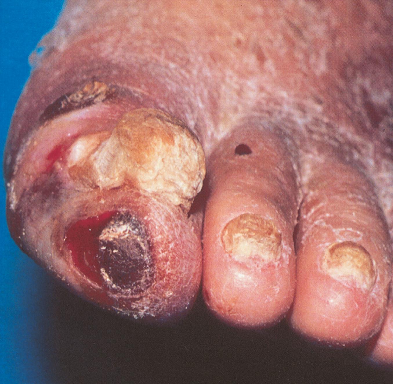 FIGURE 43.3, Typical arterial ulcer. Discrete, circumscribed, necrotic ulcer located on the great toe.