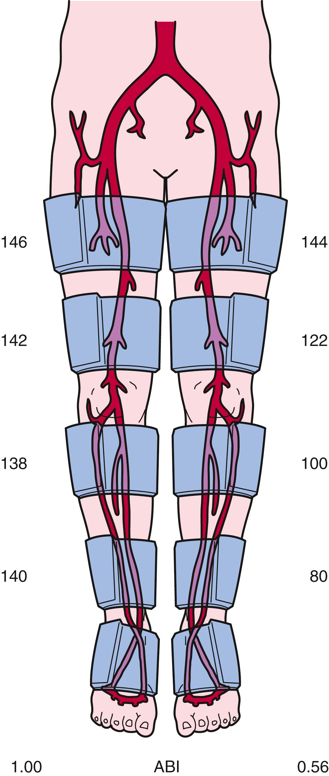 FIGURE 43.4, Segmental pressure measurements in a patient with intermittent claudication of the left calf. A pressure gradient is present between the left upper and lower thigh cuffs, lower thigh and calf cuffs, and calf and ankle cuffs, consistent with multisegmental disease affecting the femoral-popliteal and tibial arteries. The left ABI is 0.56, which is abnormal. Segmental pressure measurements and the ABI in the right leg are normal.