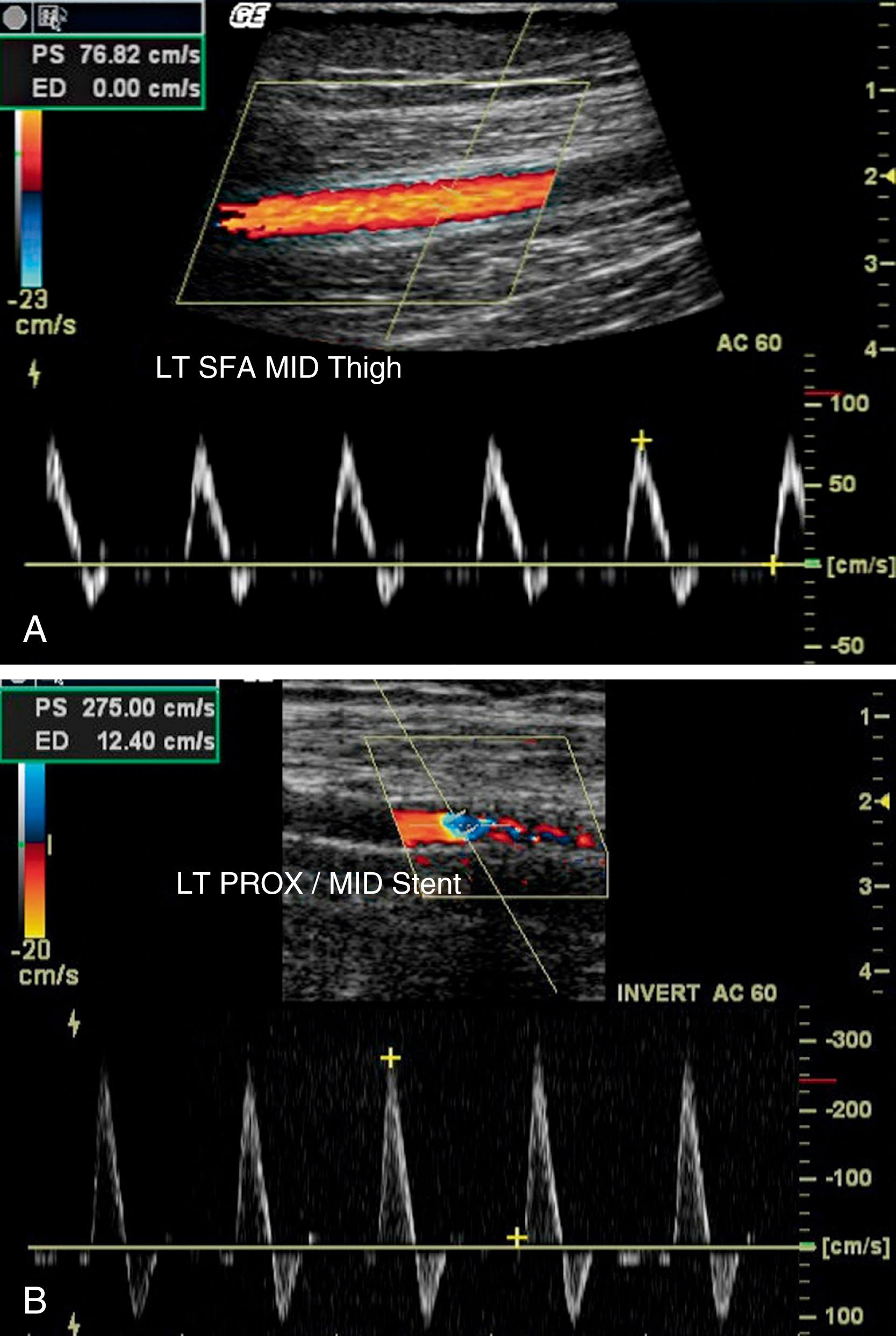 FIGURE 43.5, Duplex ultrasonogram of the common femoral artery (CFA) bifurcation into the superficial femoral artery (SFA) and deep femoral artery. A, Normal gray-scale image of the artery in which the intima is not thickened and the lumen is widely patent. B, Recording of the pulse Doppler velocity sampled from the superficial femoral artery. The triphasic profile is apparent, the envelope is thin, and peak systolic velocity is within normal limits.