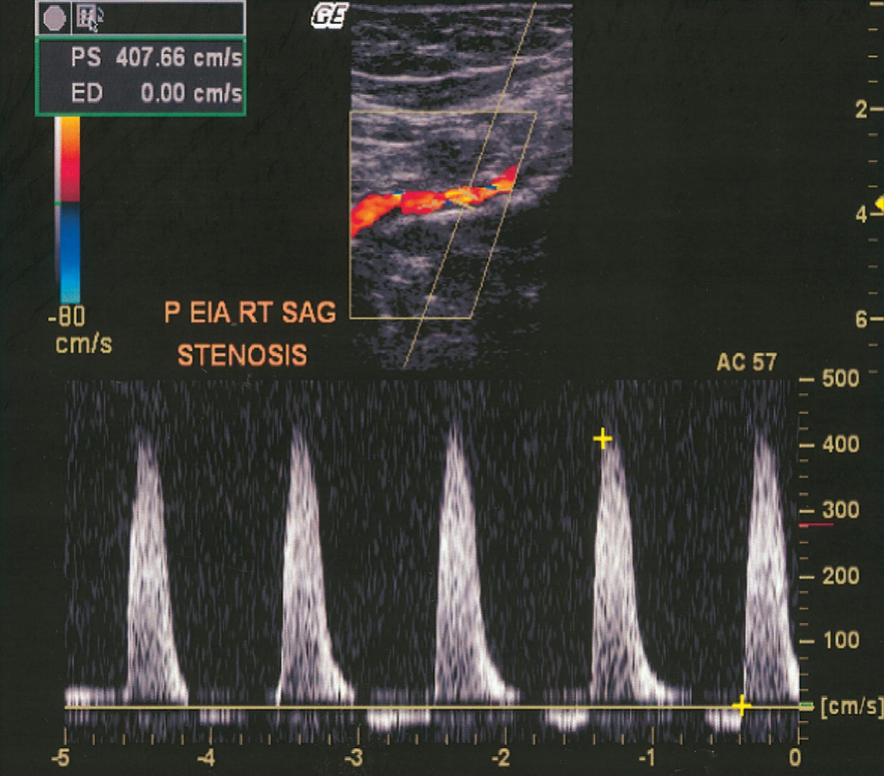 FIGURE 43.6, Duplex ultrasonogram of the external iliac artery. Top, Color image of the artery in which there is heterogeneity and desaturation of color, indicative of high-velocity flow through a stenosis. Bottom, Recording of the pulse Doppler velocity sampled from the right external iliac artery. The peak velocity of 350 cm/sec is elevated. These features are consistent with a significant stenosis.