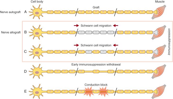 Figure 68.2, Effects of premature immunosuppression withdrawal in nerve allograft.