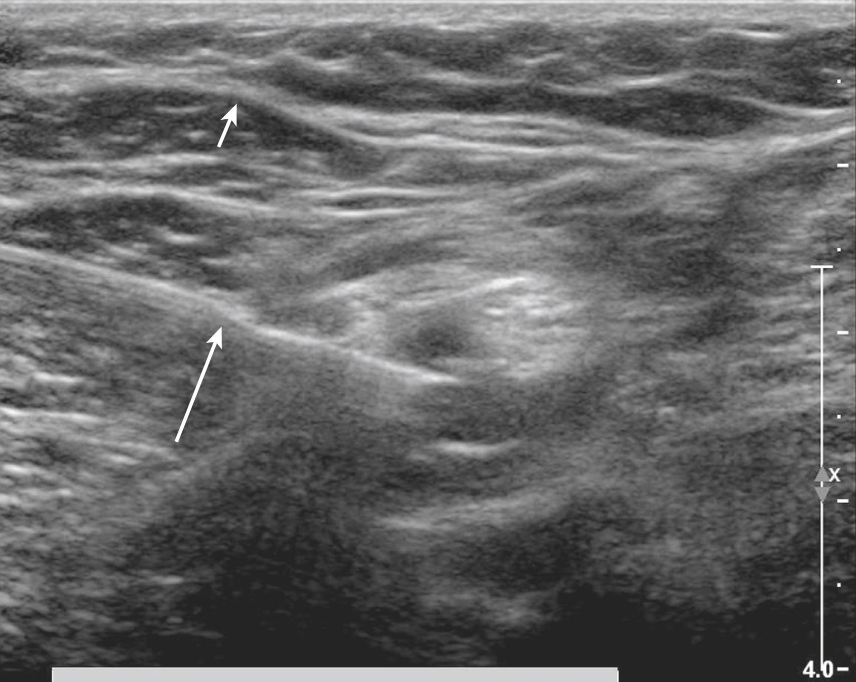 Fig. 46.1, Bayonet artifact is observed during popliteal block of the sciatic nerve.