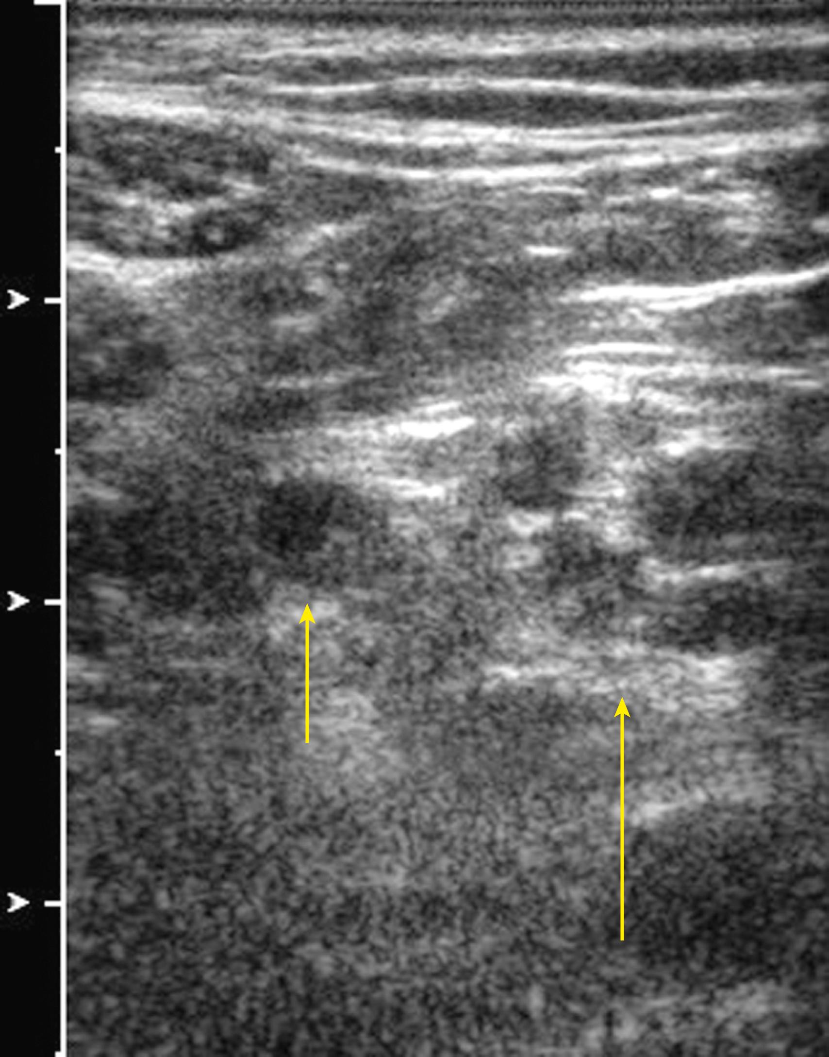 Fig. 46.13, Sonogram demonstrates the popliteal fossa of a patient with Charcot-Marie-Tooth, type 1A, disorder.