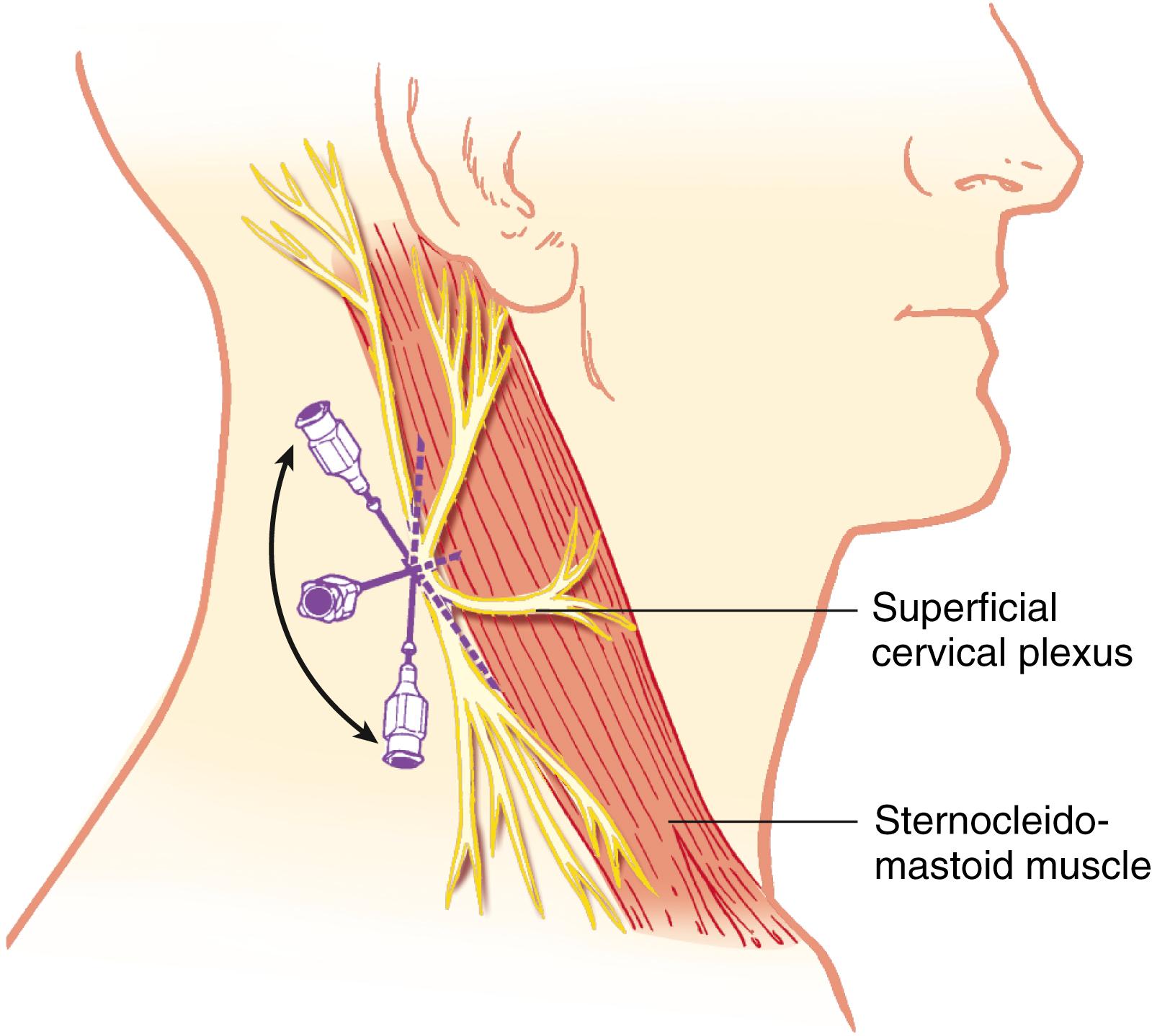 Fig. 46.15, Anatomic landmarks and method of needle placement for a superficial cervical plexus block.