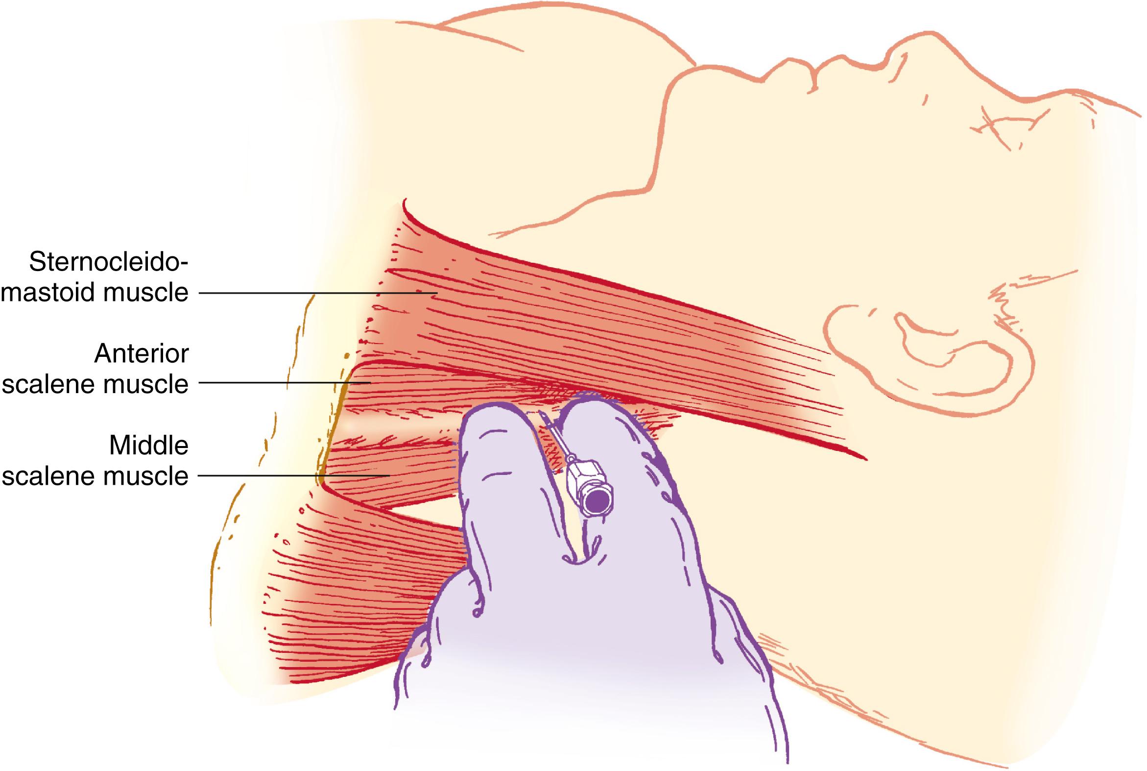 Fig. 46.18, Interscalene block guided by palpation.