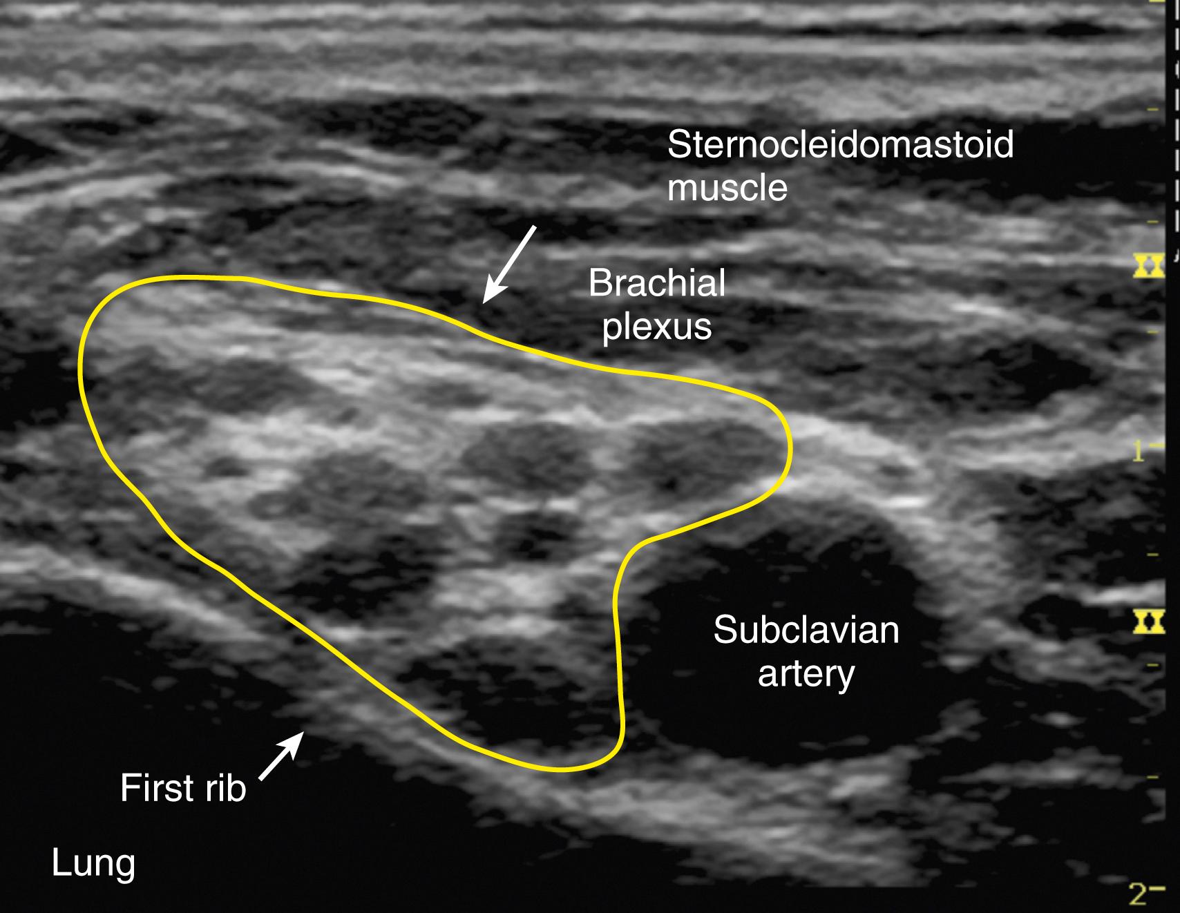 Fig. 46.19, Ultrasound image of the brachial plexus at the level of the first rib.