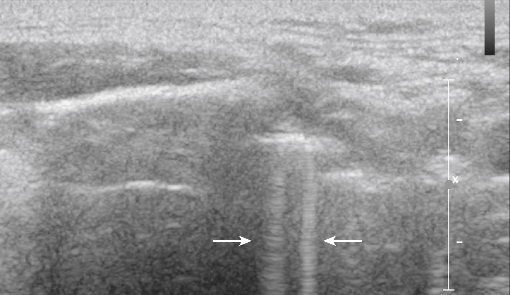 Fig. 46.3, Comet-tail artifact is observed during the scanning of the upper airway (arrows) . Small collections of water near the air interface, which also are seen during scanning of the pleura, generate this artifact.