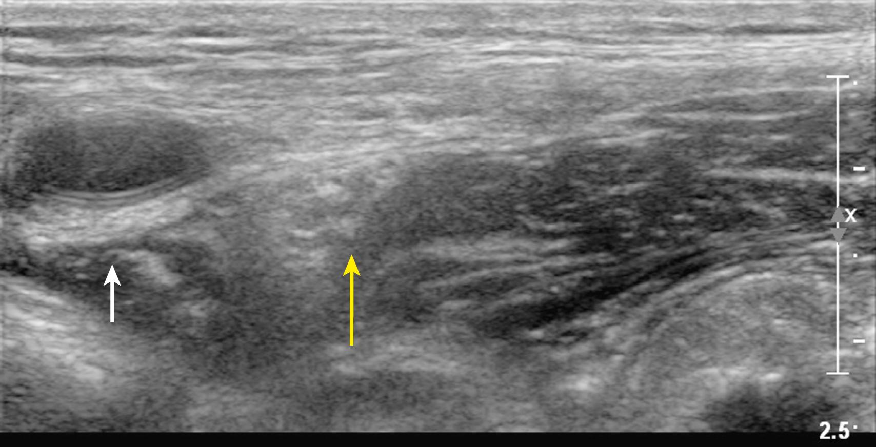 Fig. 46.4, Posterior acoustic enhancement artifact is observed during femoral nerve block.
