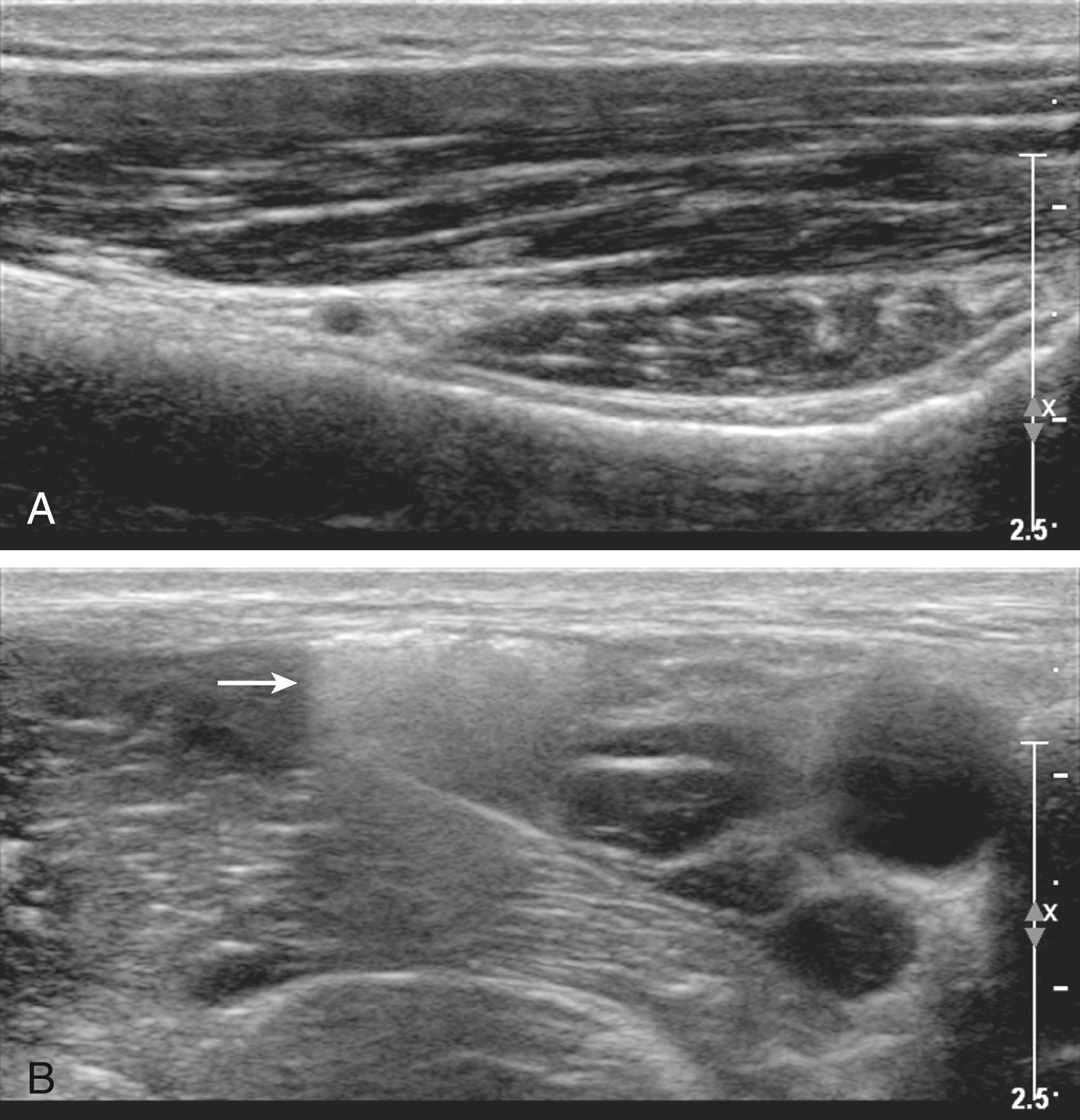 Fig. 46.5, Acoustic shadowing occurs during regional blocks.