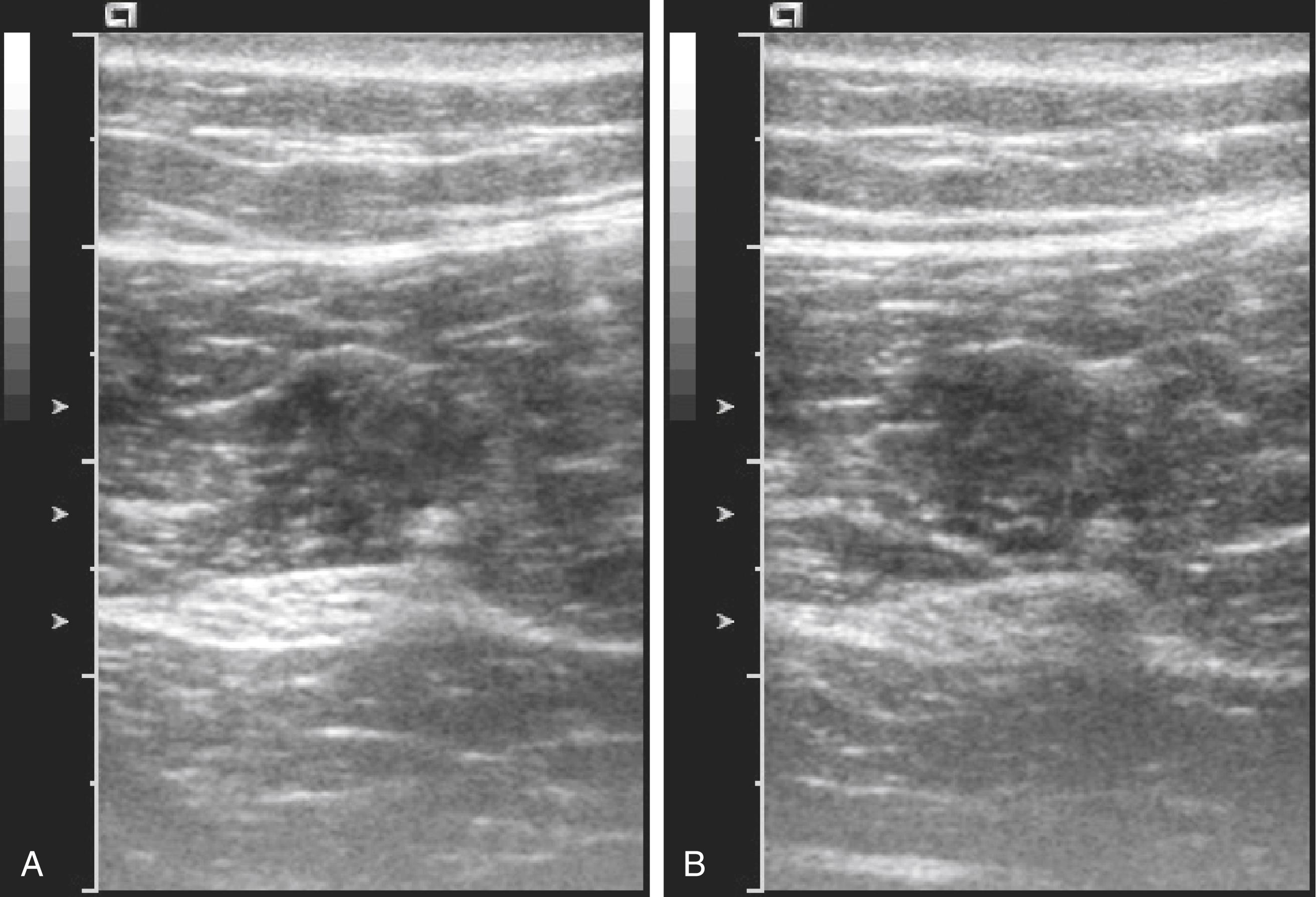 Fig. 46.7, (A) Sciatic nerve imaging in the subgluteal region. (B) The amplitude of the received echoes diminishes when the angle of insonation is changed away from perpendicular to the nerve path, thereby demonstrating anisotropy.