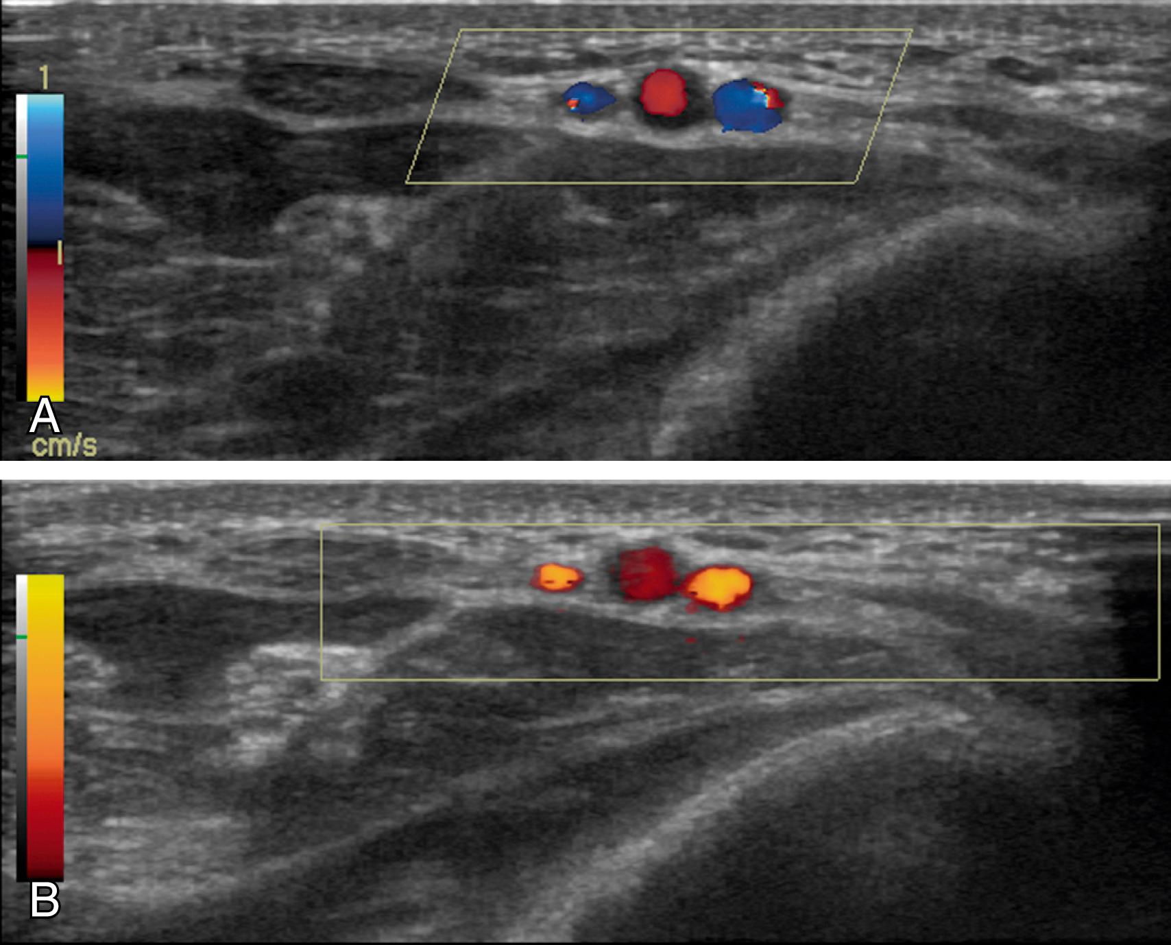 Fig. 46.9, Duplex sonograms illustrate the Doppler shift.