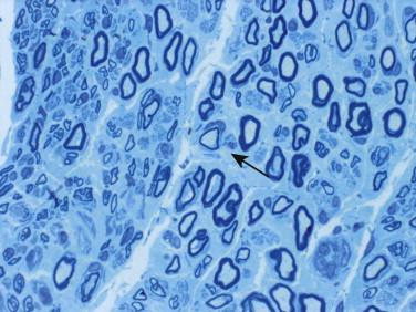 Fig 1, Peripheral nerve disorders. Toluidine blue–stained section of peripheral nerve reveals large diameter axons with thin myelin sheath ( arrow ), suggestive of demyelination with remyelination.