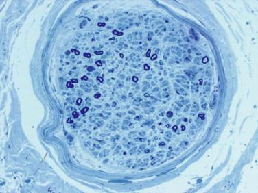 Fig 5, Peripheral nerve disorders. Toluidine blue–stained section of a peripheral nerve with chronic axonal neuropathy reveals marked reduction of large-diameter myelinated axons.