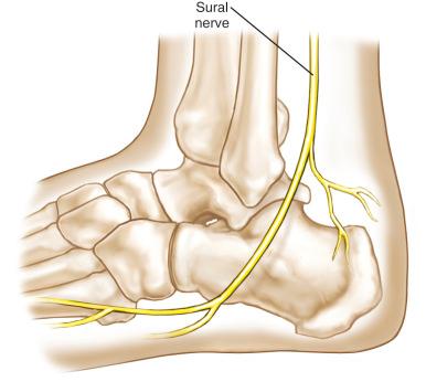 Fig. 114.2, The image shows the course of the sural nerve. For details, see text.