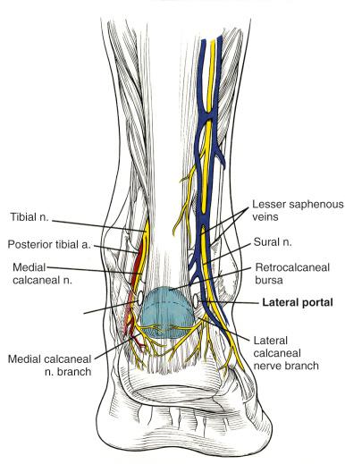 Fig. 114.3, Illustrated is the posterior anatomy of the hindfoot with regard to arthroscopic portals. The sural nerve can be injured when inserting the scope through the posterolateral portal.