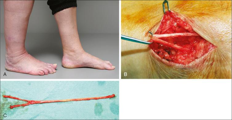 Fig. 114.4, (A) Illustrated is the right foot and leg of a 55-year-old patient who has previously been treated by means of a calcaneal osteotomy. Unfortunately, he developed therapy-refractory pain along the course of the sural nerve. (B) The nerve has been approached over its point of maximum tenderness. Intraoperative findings revealed that the bifurcation has been entrapped and damaged. (C) Intraoperative photograph of the resected sural nerve.