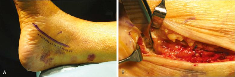 Fig. 114.8, (A) The surgical approach to the tarsal tunnel is outlined. Depending on the nerve, branches involving a slightly more anterior or posterior position of the skin incision should be chosen. In this case, it has been chosen a little bit more anterior to release the main tibial nerve. (B) The same patient is depicted as mentioned in (A). The tarsal tunnel has been released and the tibial nerve decompressed.