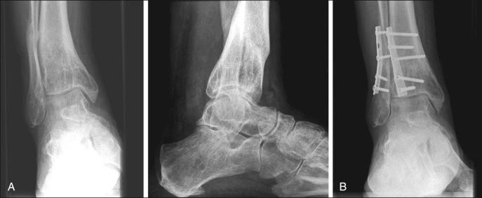 Fig. 114.9, (A) Illustrated is a case of a 64-year-old male patient who suffered from both posttraumatic ankle arthrosis and tarsal tunnel syndrome. To compensate for the clearly visible varus deformity, the patient exerted too much eversion at the subtalar joint, with subsequent stretching of the tibial nerve. (B) Depicted are the postoperative radiographs of the same patient as presented in (A). A supramalleolar osteotomy has been performed together with a tarsal tunnel release. One year after surgery, the patient was completely pain-free and very satisfied. Realignment resulted in unload of the ankle as well as subtalar joint.