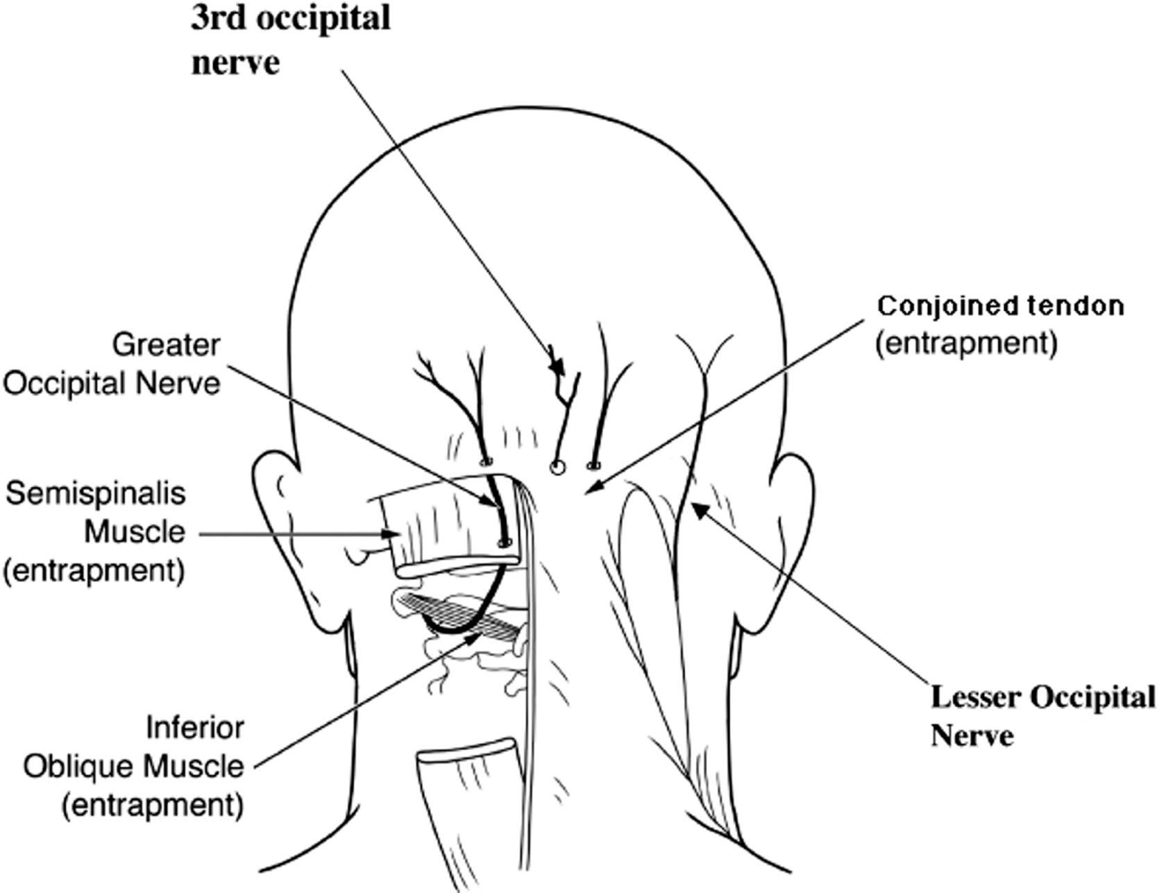 Figure 2.1, Greater, lessor, and third occipital nerves and their site of entrapment.