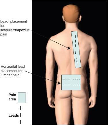 Figure 61.2, Schematic representation of different electrode placement strategies for different pain areas.