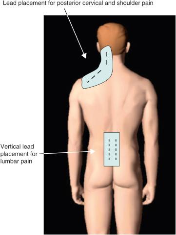 Figure 61.3, Schematic representation of different electrode placement strategies for different pain areas.