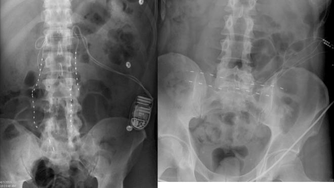 Figure 61.5, Horizontal and vertical lumbar leads placement.