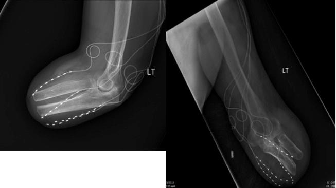 Figure 61.6, Forearm placement for intractable stump pain.