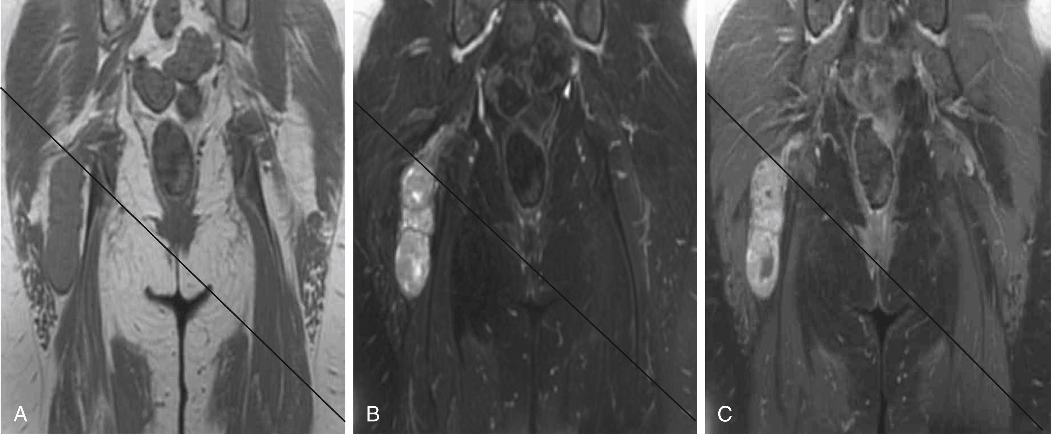 Fig. 190.1, Magnetic resonance image (MRI) of a sciatic nerve schwannoma. Coronal MRI demonstrates a well-circumscribed tumor involving the right sciatic nerve that is (A) isointense to muscle on T1, (B) hyperintense on T2, and (C) enhancing after gadolinium administration. Note small areas of cystic necrosis.