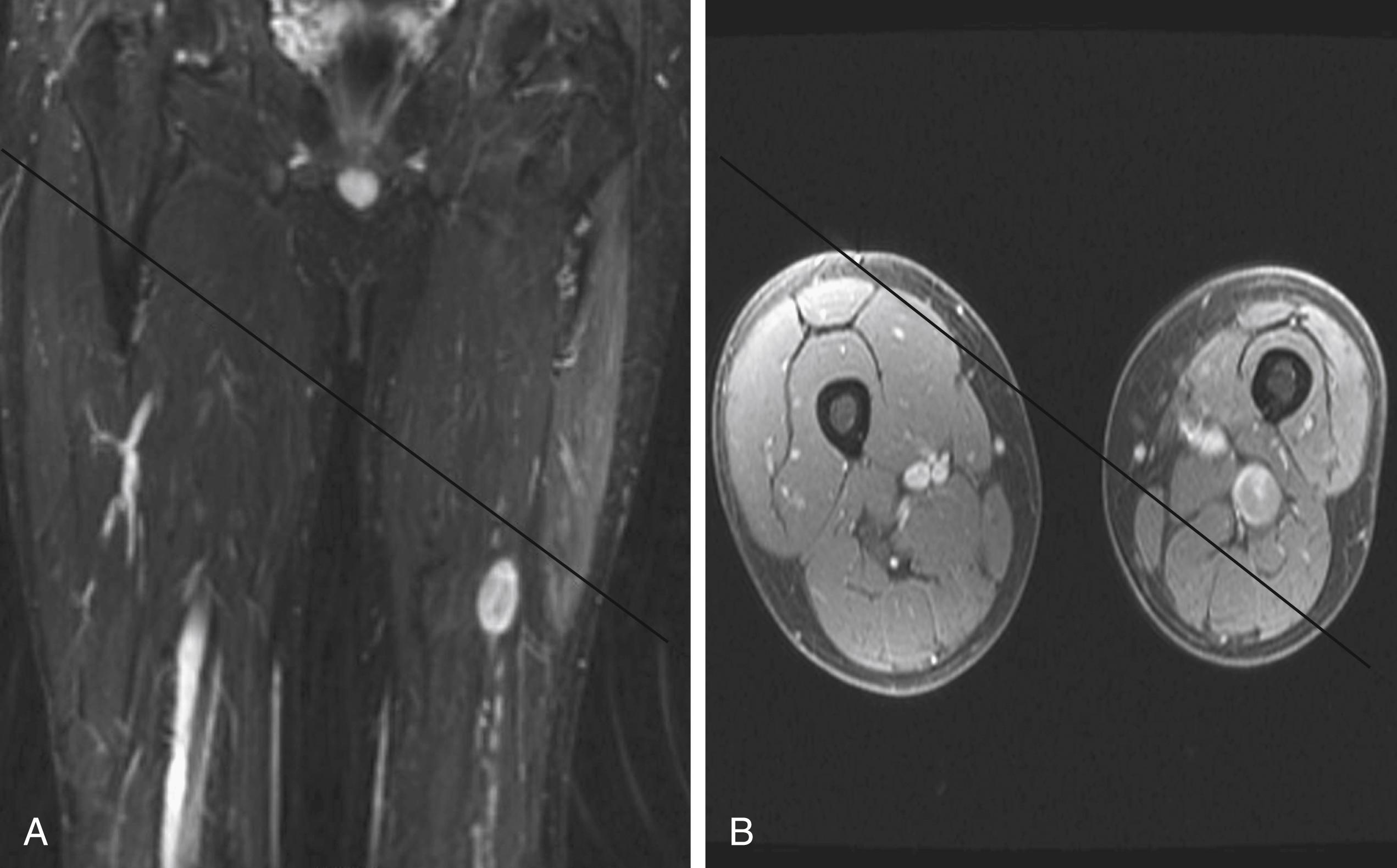 Fig. 190.2, Magnetic resonance image of a sciatic nerve neurofibroma in a patient with neurofibromatosis type 1. (A) T2-weighted coronal image demonstrates a well-circumscribed tumor involving the left sciatic nerve that is hyperintense to muscle. The T2 hyperintensity changes seen in the muscle represent denervation changes due to the presence of a plexiform neurofibroma proximally, involving left lumbar plexus. (B) T1-weighted postgadolinium image demonstrates a heterogeneous enhancement. Note that the lumbar plexus plexiform neurofibroma has caused considerable denervation muscle atrophy in the left thigh.