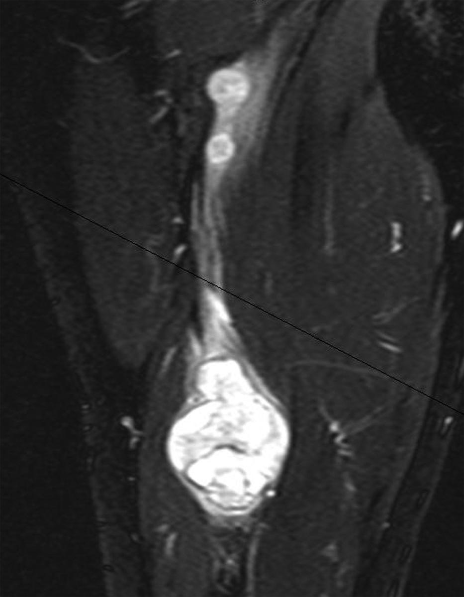 Fig. 190.3, Magnetic resonance image of a sciatic nerve schwannoma in a patient with schwannomatosis. A coronal T2-weighted image demonstrates multiple discrete hyperintense tumor nodules arising from the right sciatic nerve, characteristic of schwannomatosis.