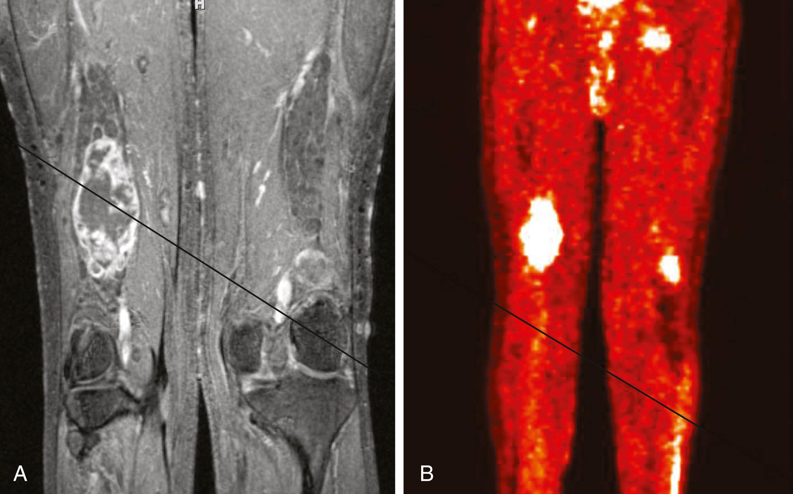 Fig. 190.4, Magnetic resonance image and 18 fluorodeoxyglucose positron emission tomography ( 18 FDG-PET) of a malignant peripheral nerve sheath tumor of the sciatic nerve. (A) Coronal T1-weighted postgadolinium image demonstrates a large, infiltrative, heterogeneously enhancing tumor of the right sciatic nerve with areas of necrosis. (B) Coronal FDG-PET scan demonstrating marked uptake within the right sciatic nerve tumor.