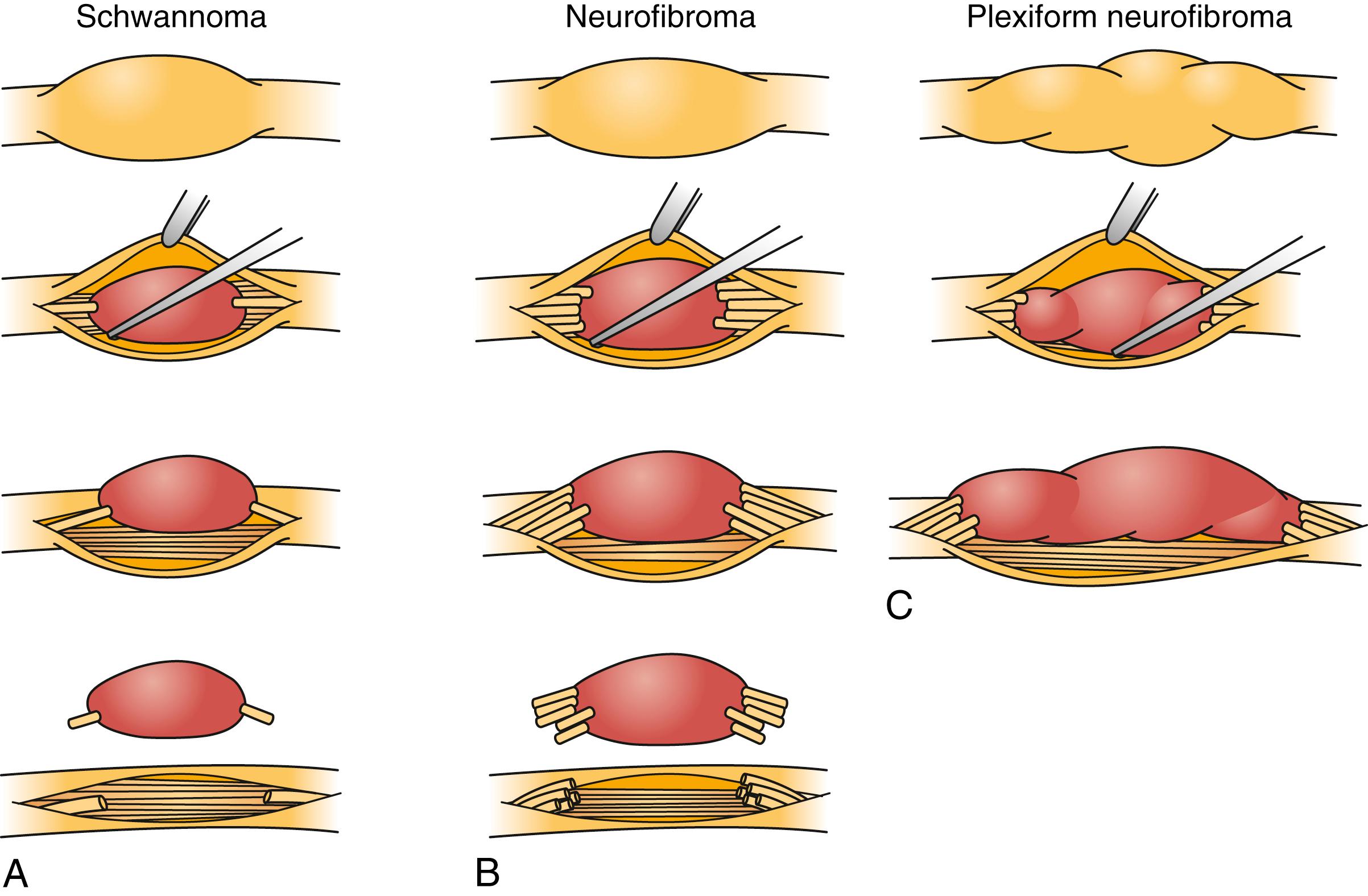 Fig. 190.5, Schematic illustration of surgery for benign peripheral nerve sheath tumors. (A) Schwannoma resection. The tumor causes well-circumscribed dilatation of the nerve. Internal neurolysis shows that the tumor has thinned and displaced the fascicles. A single small fascicle may be enveloped by tumor. The fascicles surrounding the schwannoma are dissected free, the tumor capsule is opened, and the schwannoma and any enveloped fascicles are resected en bloc. (B) Neurofibroma resection. Neurofibromas cause well-circumscribed nerve dilatation (similar to schwannomas). However, unlike schwannomas, neurofibromas envelop, rather than displace, the majority of fascicles. After internal neurolysis, the tumor is seen enveloping multiple nerve fascicles. The neurofibroma and enveloped fascicles are resected en bloc. Nerve grafts may be required to repair functional fascicles that were resected. (C) Plexiform neurofibroma debulking. The plexiform neurofibroma has caused fusiform dilatation of the affected nerve. Intraneurally, the tumor has enveloped many fascicles. The tumor is debulked, but it cannot be fully resected.