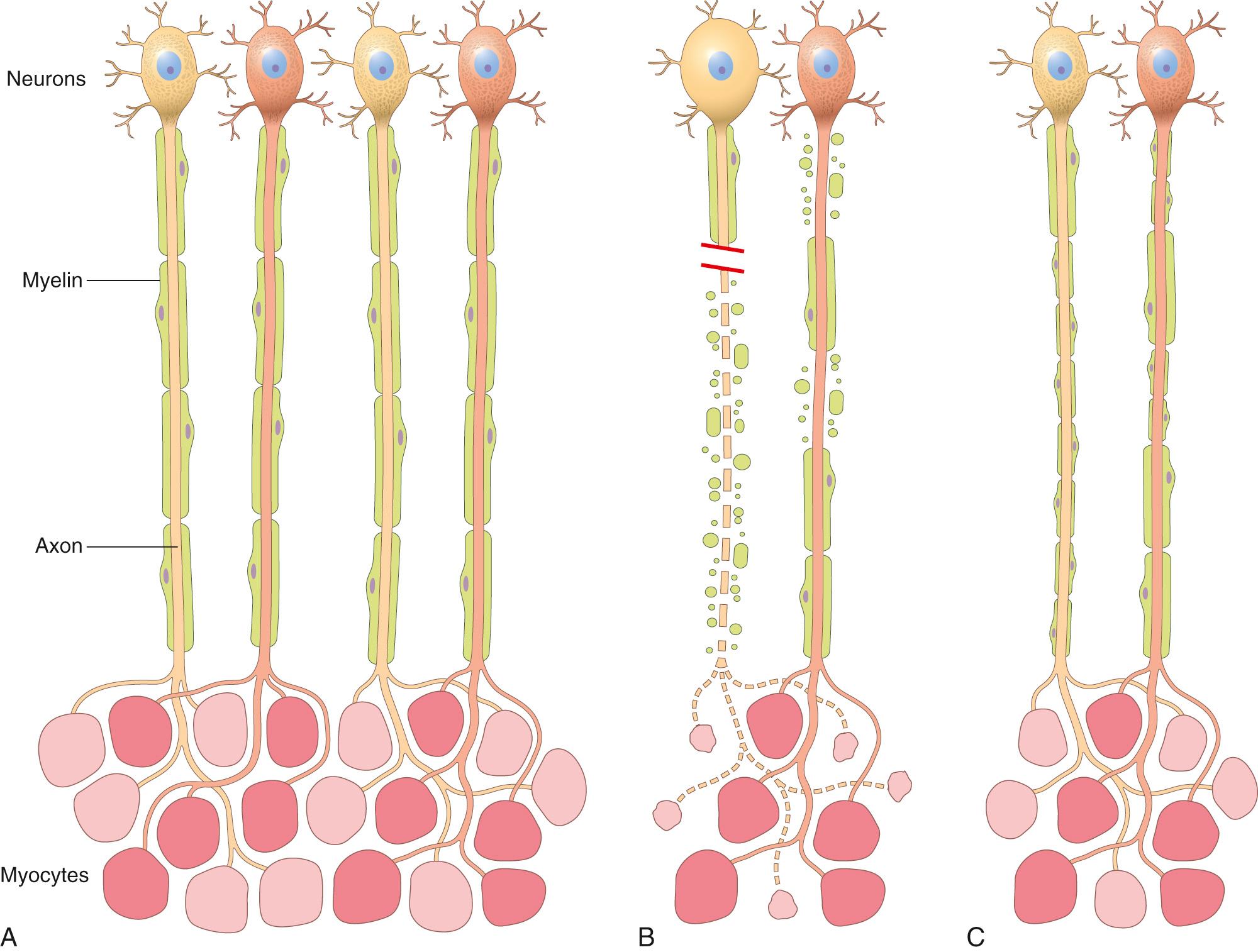 Figure 27.2, Patterns of peripheral nerve damage. (A) In normal motor units, type I and type II myofibers are arranged in a “checkerboard” distribution, and the internodes along the motor axons are uniform in thickness and length. (B) Acute axonal injury (left axon) results in degeneration of the distal axon and its associated myelin sheath, with atrophy of denervated myofibers. In contrast, acute demyelinating disease (right axon) produces random segmental degeneration of individual myelin internodes, while sparing the axons. (C) Regeneration of axons after injury (left axon) allows reinnervation of myofibers. The regenerated axon is myelinated by proliferating Schwann cells, but the new internodes are shorter and the myelin sheaths are thinner than the original ones. Remission of demyelinating disease (right axon) allows remyelination to take place, but the new internodes are shorter and have thinner myelin sheaths than flanking normal undamaged internodes. See Fig. 27.7 for comparison with reinnervation.