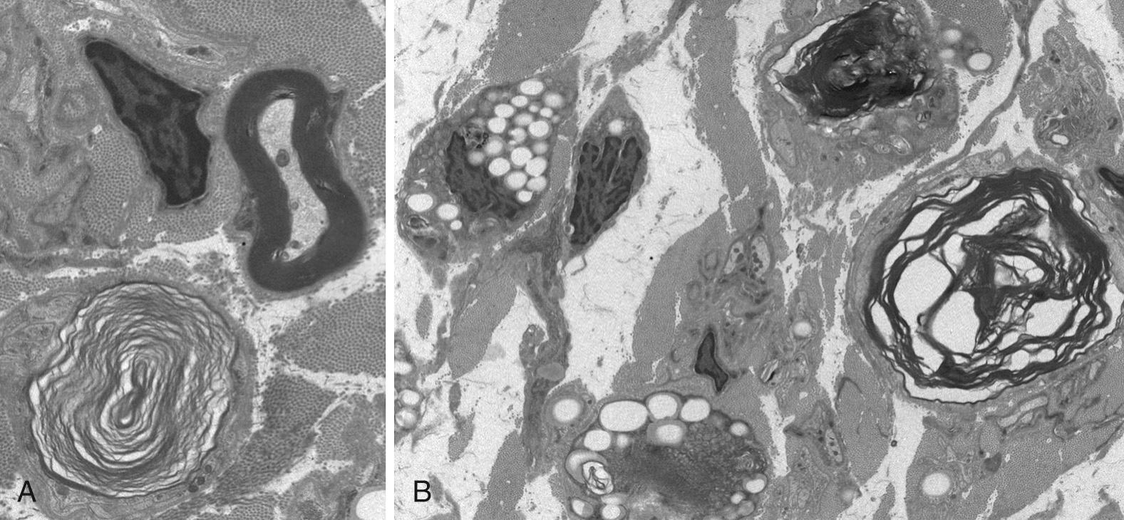 Figure 27.3, Electron micrographs illustrating features of axonal degeneration. (A) Degenerating myelin with loosened myelin layers is seen in the degenerating axon in the lower left corner, to be contrasted with a normal myelin sheath with tightly packed myelin and intact axon in the upper right corner. (B) In addition to an unraveling myelin sheath, several cells contain lipid droplets (seen as vacuoles) derived from degenerating myelin.