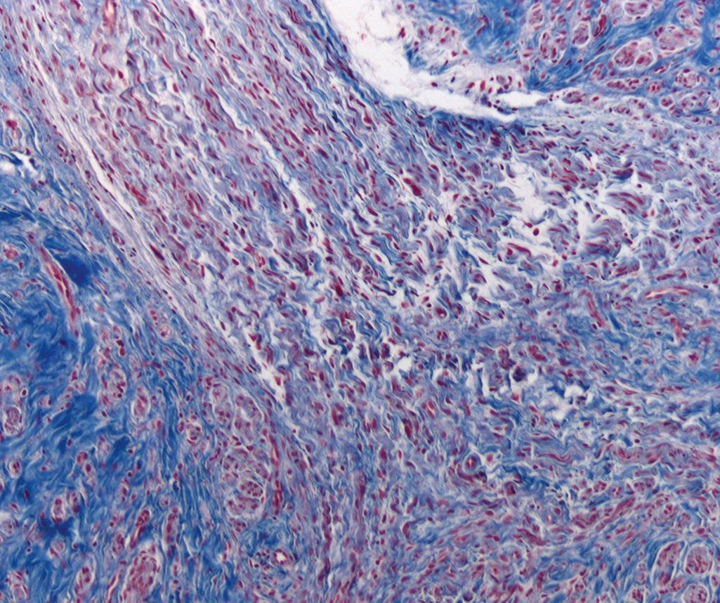 Figure 27.4, Trichrome-stained section of a traumatic neuroma showing the transition from normal nerve containing a parallel arrangement of axons (upper left corner) to a haphazard swirl of red-stained axons associated with admixture of Schwann cells and blue-staining connective tissue.