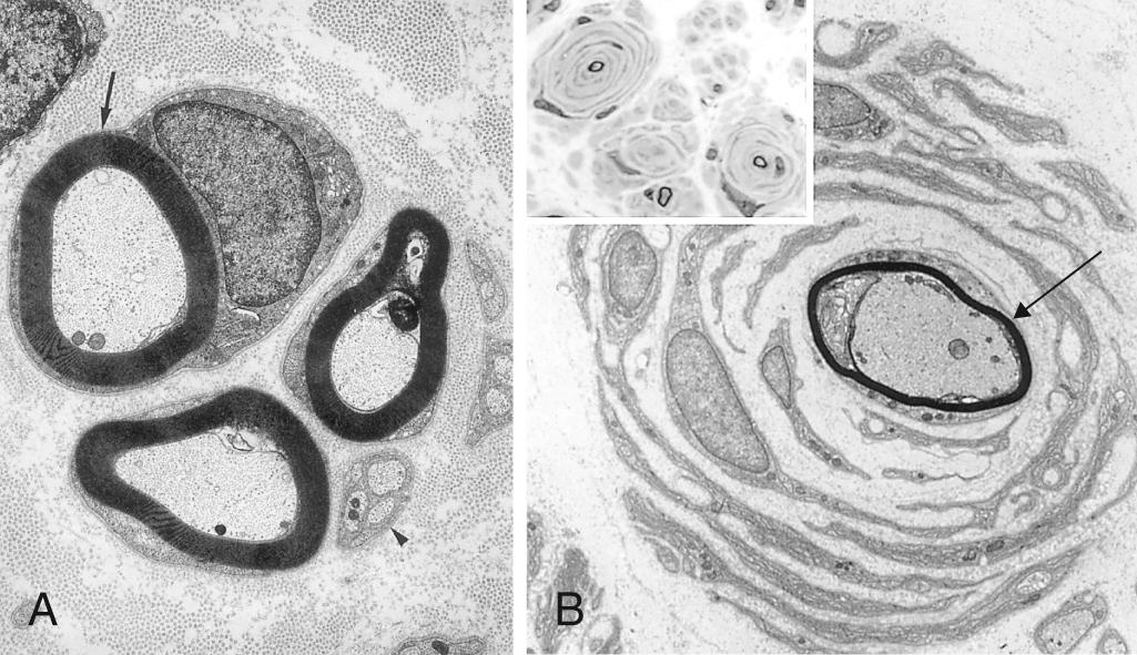 Figure 27.5, Onion bulb neuropathy. (A) shows normal myelinated axons (one that includes the nucleus of the associated Schwann cells is marked with an arrow) and unmyelinated axons (arrowhead) . Compared with the normal ultrastructure of axons in a nerve (A), an “onion bulb” (B) is composed of a thinly myelinated axon (arrow) surrounded by multiple concentrically arranged Schwann cells. Inset, Light microscopic appearance of an onion bulb neuropathy, characterized by “onion bulbs” surrounding axons.