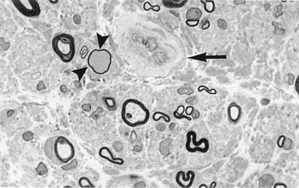 Figure 27.6, Diabetic neuropathy with marked loss of myelinated fibers, a thinly myelinated fiber (arrowheads), and thickening of endoneurial vessel wall (arrow).