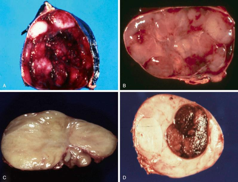 Fig. 28.1, Gross Appearance of Peripheral Neuroblastic Tumors.