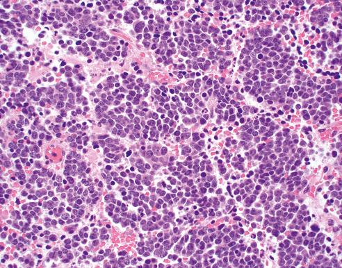 Fig. 28.2, Neuroblastoma (Schwannian Stroma-Poor), Undifferentiated Subtype.