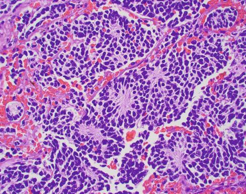 Fig. 28.3, Neuroblastoma (Schwannian Stroma-Poor), Poorly Differentiated Subtype.