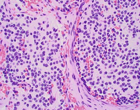 Fig. 28.4, Neuroblastoma (Schwannian Stroma-Poor), Poorly Differentiated Subtype.